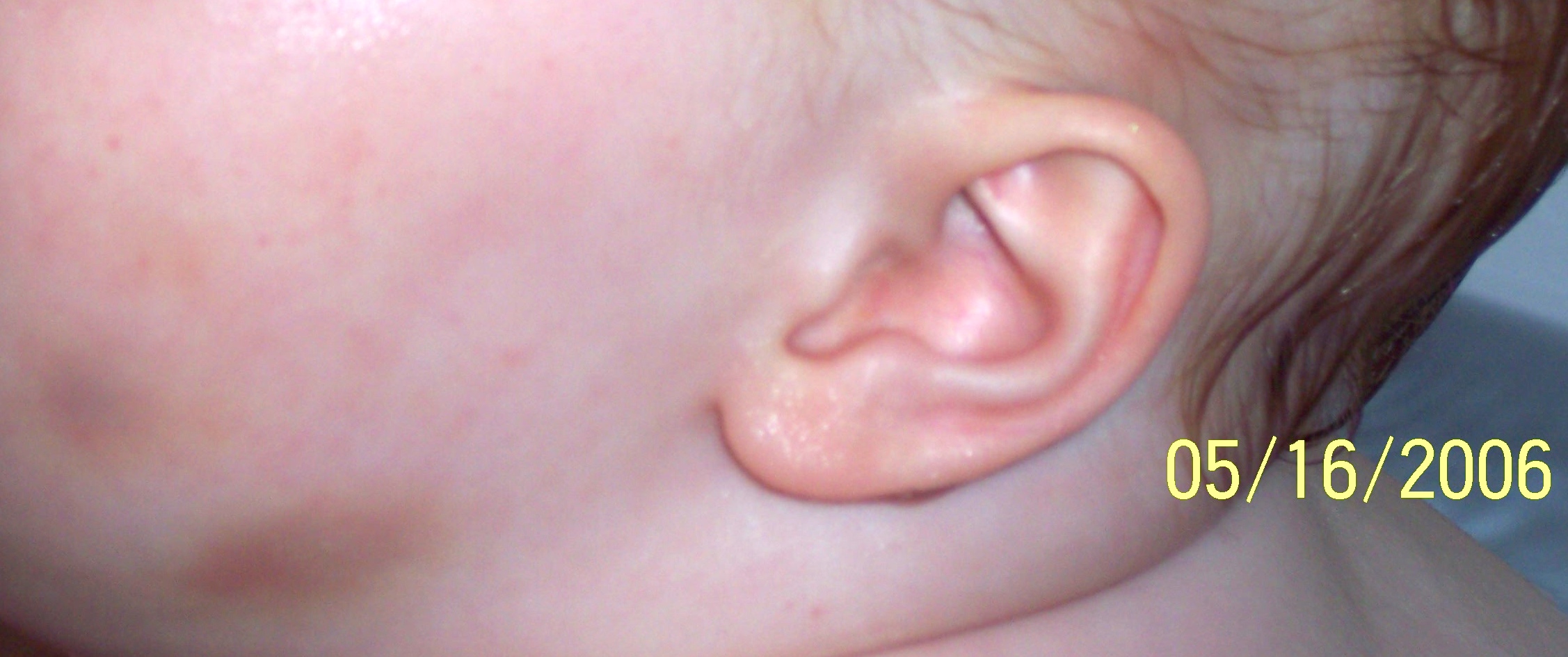 'Joshua' injury 2